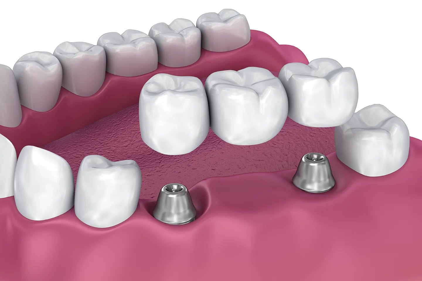 Prótese dentária